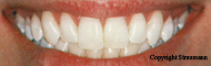 Bielenie zubov
